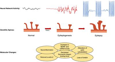 The role of dendritic spines in epileptogenesis